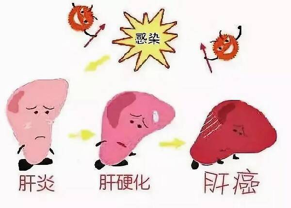 乙肝的癥狀有哪些？